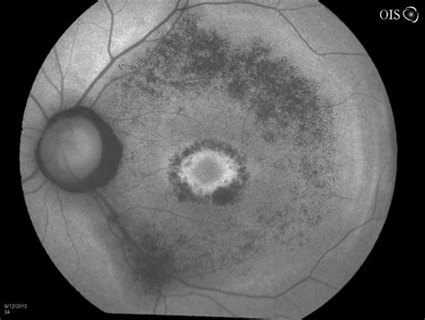 Bull's Eye Maculopathy Without Plaquinel - Retina Image Bank