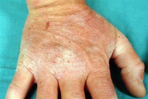 Mild Dermatitis Herpetiformis On Hands