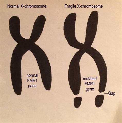 Fragile X Syndrome Body