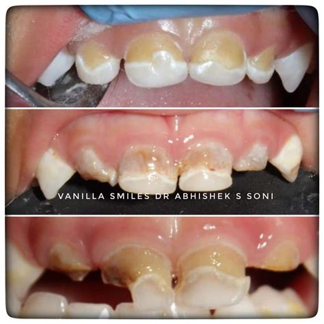 What is Early Childhood Caries? Causes & Treatment.