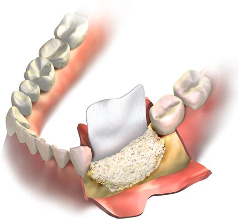 Bone Graft After Wisdom Teeth Removal: Is it necessary? - Dr. Tye