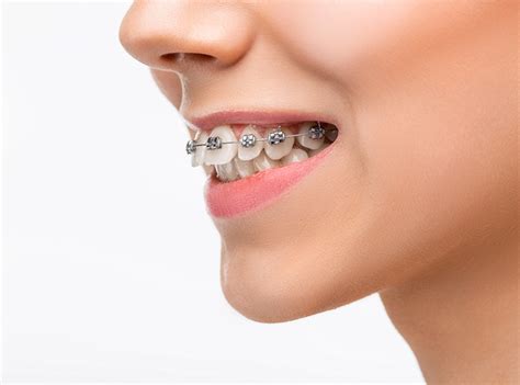 Overbite/Overjet: Causes, Symptoms & How is it Treated? « Smile Team ...