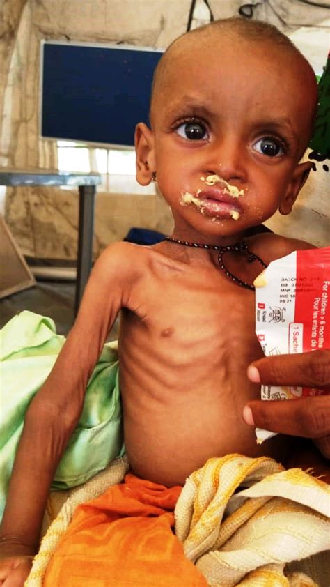 Malnutrition causes nearly half of all child deaths -UNICEF