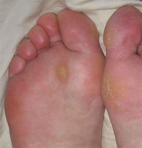 Podiatric Foot Care - Care Home Podiatry