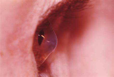 Keratoconus 2 | Hereditary Ocular Diseases