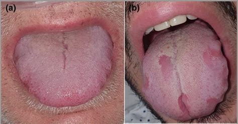 Doctores advierten: "Lengua de COVID" podría ser uno de síntomas del coronavirus — Radio ...