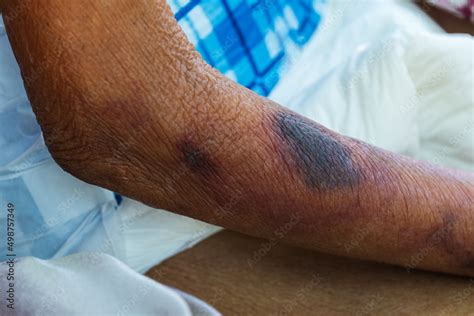 Blood bruises under the skin of an elderly patient Stock Photo | Adobe ...