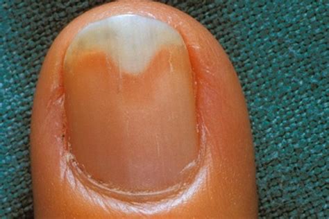 Toenail Bed Problems at Laura McLendon blog