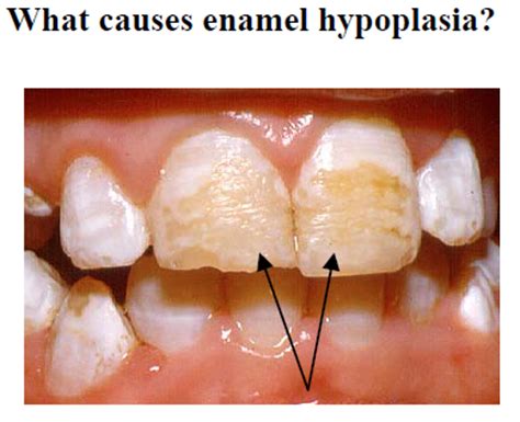 Enamel Hypoplasia