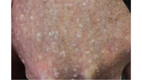 Stucco Keratosis: Causes, Symptoms and Treatments | Skin Cancer Specialists