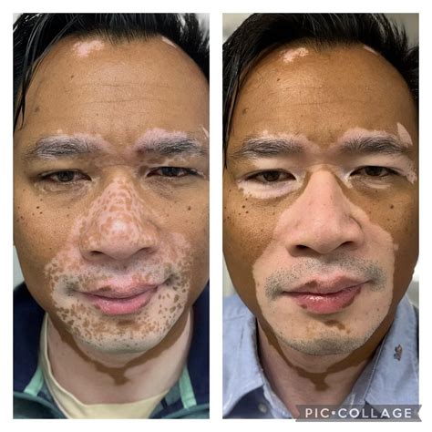 Opzelura 2 mois de progrès : r/Vitiligo