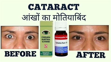 CATARACT(आँखों का मोतियाबिंद )HOMOEOPATHIC TREATMENT - YouTube