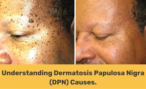 Understanding Dermatosis Papulosa Nigra (DPN) Causes. - Beauty Bloom Box