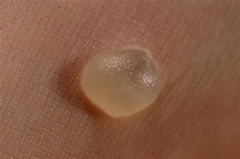 5 Simple Ways to Get Rid of Blisters