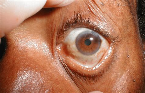 Eye Discoloration: Why Does It Happen? - EzineMark