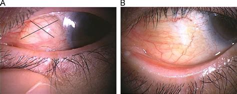 Clinical evaluation of a novel surgical technique (large cross incision ...