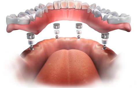 The Advantages of Implant Supported Dentures - East Hanover Family Dental East Hanover New Jersey