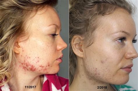 Acne Before And After Birth Control