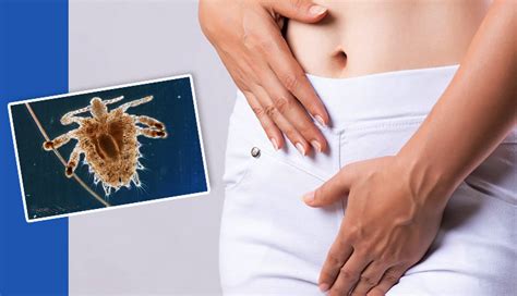 9 Home Remedies To Help You Get Rid of Pubic Lice - lifeberrys.com
