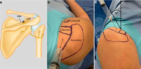 Suprascapular nerve blockade. The approach to the suprascapular nerve,... | Download Scientific ...