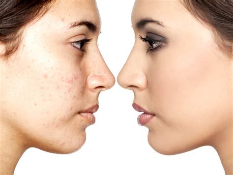 5 best ways to remove blemishes naturally | The Times of India