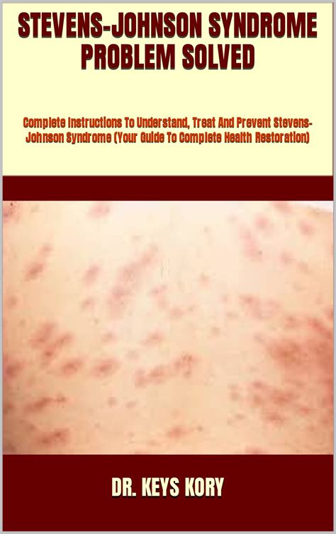 Buy STEVENS-JOHNSON SYNDROME PROBLEM SOLVED : Complete Instructions To Understand, Treat And ...