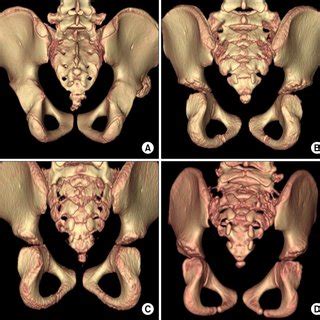 Classification of the sacral hiatus by three-dimensional CT image; (A)... | Download Scientific ...