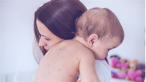 Vaccinations and the measles resurgence | Smart Talk