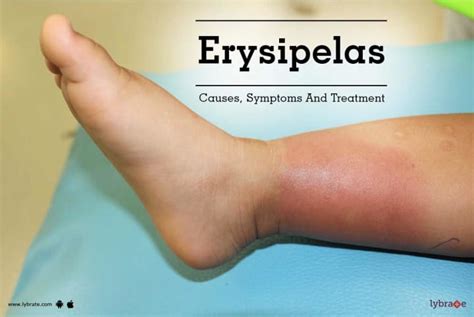 Erysipelas - Causes, Symptoms And Treatment - By Dr. Vinod Chavan | Lybrate