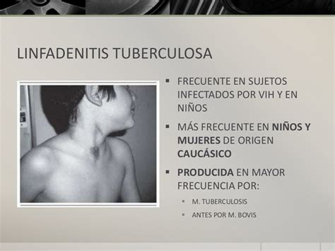 Tuberculosis extrapulmonar, tratamiento, infectología, patología, pat…