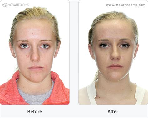 Tmj Surgery Before And After Photos – SkinTots.com