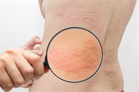 10 Best Home Remedies For Hives (Urticaria)