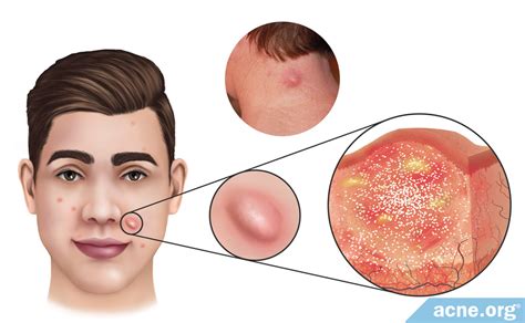 Acne Nodules On Face