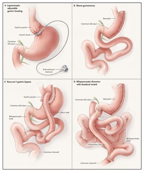 Bariatric Surgery for Morbid Obesity | NEJM