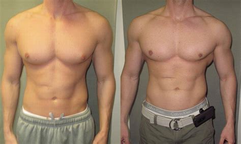 Gynecomastia: Understanding the Causes, Symptoms, Treatment, and Prevention