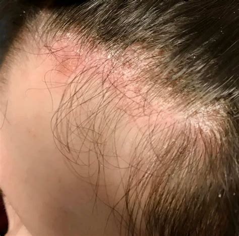 List 94+ Pictures Show Pictures Of Scalp Psoriasis Stunning