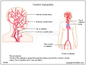Cerebral Angiography in Nashik | Dr Shripal Shah