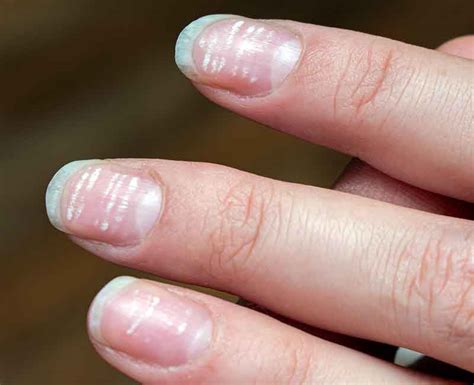 White Spots on Nails (Leukonychia): Causes & Treatment