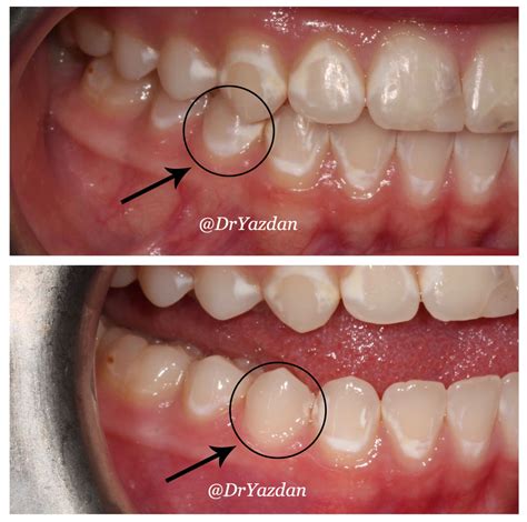 Dehydrated White Spots Teeth