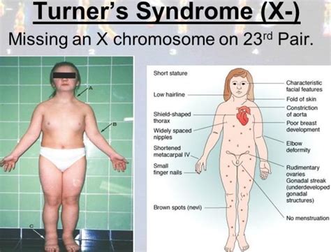 Turner Syndrome: Causes, Picture, Symptoms And Treatment