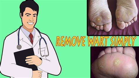 How to Get Rid of Plantar Warts | Remove Warts Naturally at Home | Best Way to Get Rid of ...
