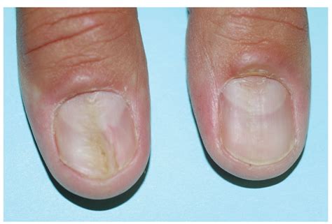 Onychomycosis: Current Trends in Diagnosis and Treatment | AAFP