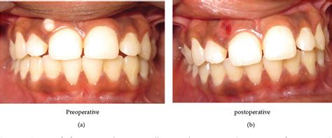 Figure 1 from An Unusual Case Report of Erupted Odontoma | Semantic Scholar