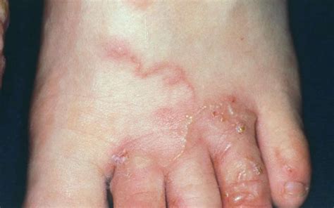 Creeping eruption, causes, symptoms, diagnosis, treatment & prognosis