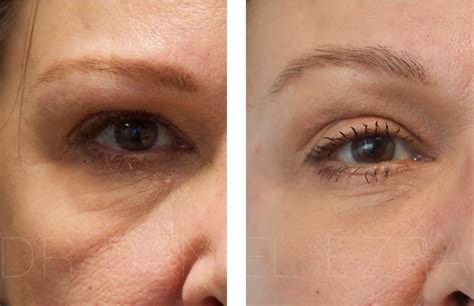 Achieving Smooth Under-Eye Skin: Exploring the Efficacy of RF ...