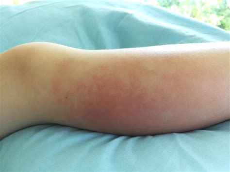 ASSET Score Provides Reliable Indication for IV Antibiotics in Children With Cellulitis ...