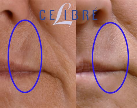 Sculptra Before and After Pictures