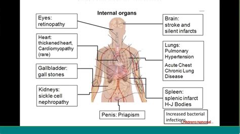 Principles of pain management and warning signs of sickle cell disease ...