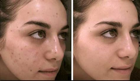 Dark Spots on Face Causes and Removal Ways - Skincarederm