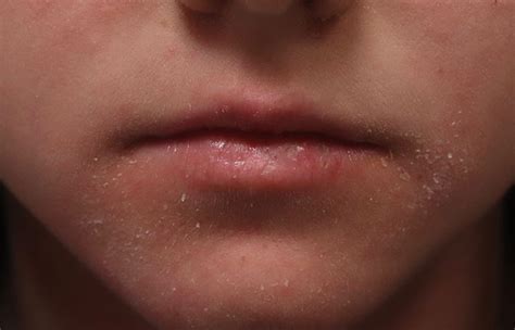 Eczema On Lips Treatment | Lipstutorial.org